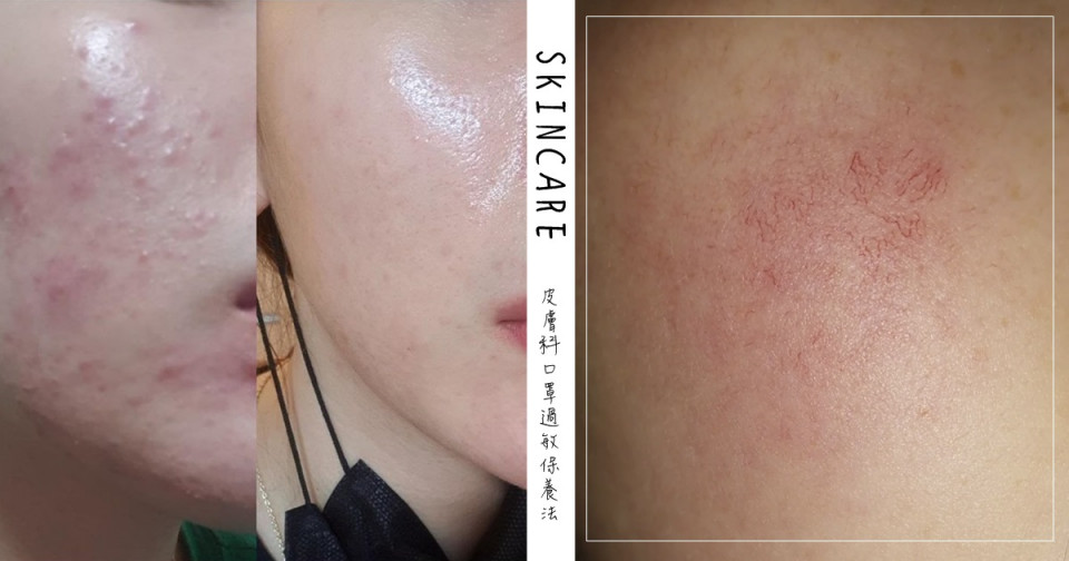 戴口罩易引發肌膚問題1：長痘痘、黑頭