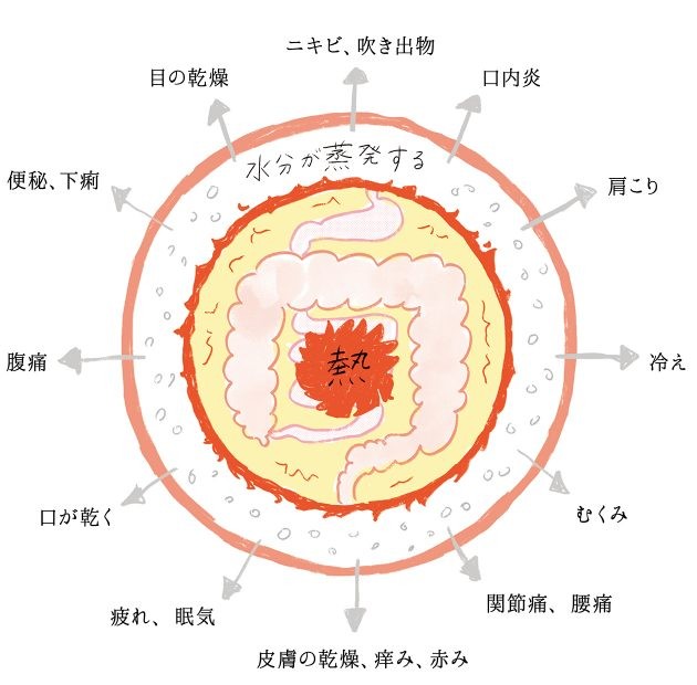 夏の冷えとほてりの原因 腸熱こもり症 を知っていますか