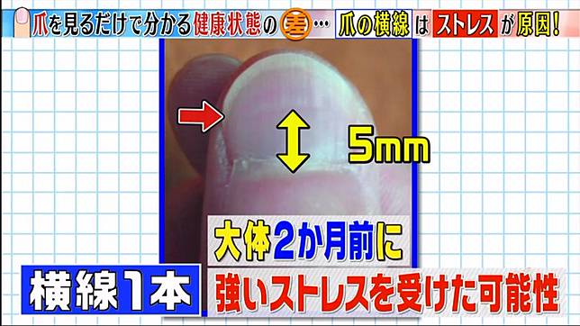 直紋 黑點 向外生 日本專家分析六種指甲特徵和健康關係 日本集合 Line Today