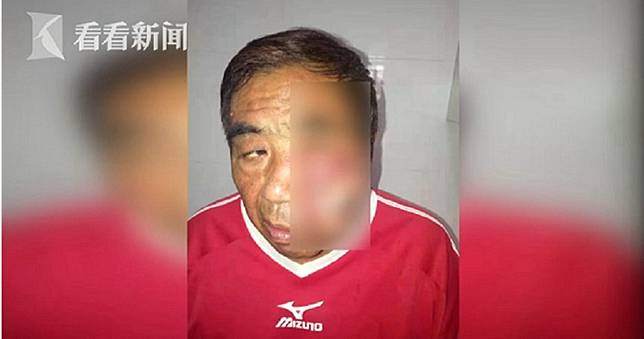 男子睡夢中被蚊子叮　竟「爆腫5公分」整臉皮膚壞死　