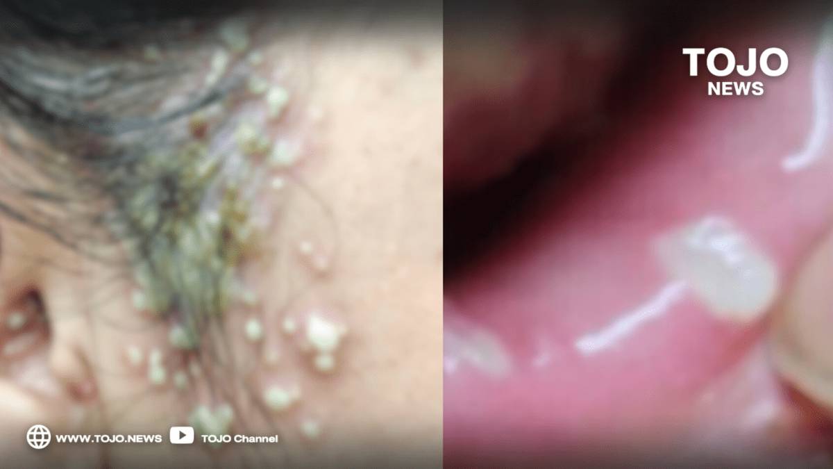 Dr. Manoon Encounter: A Rare Case of Spreading Shingles