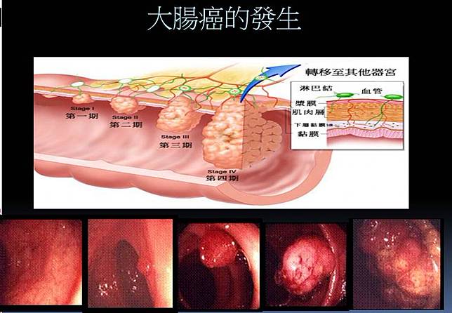 大腸鏡檢查前的清腸你做對了嗎 Nownews 今日新聞 Line Today