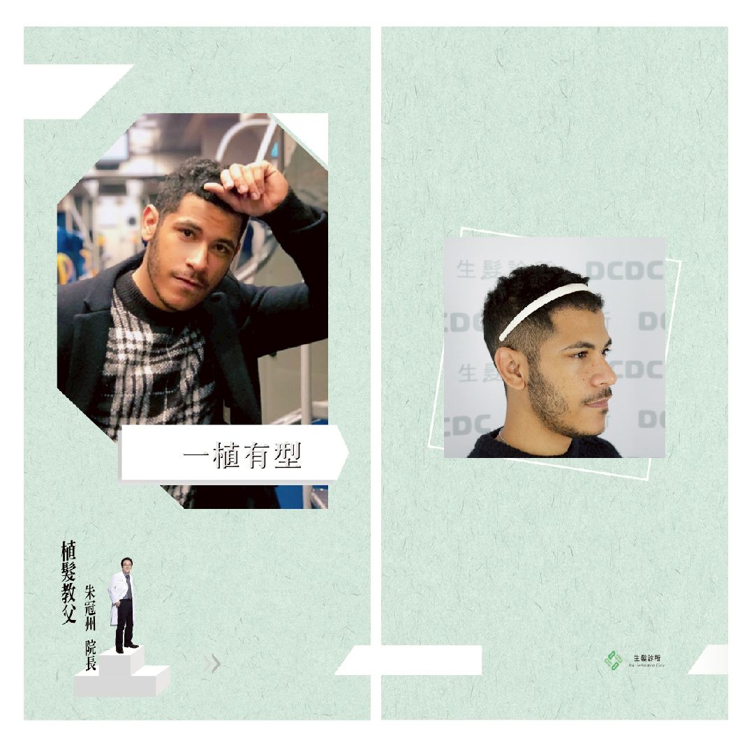 讓DCDC拉開你與「禿」的距離