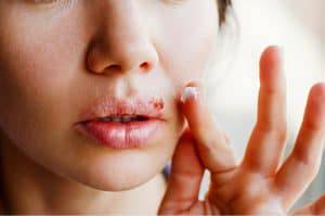 要見人等不了？治療加速唇疱疹癒合