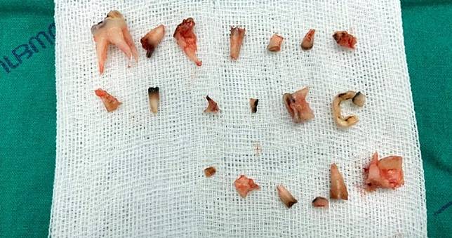 疏於照顧！4歲童20顆乳牙「蛀爛全拔光」只剩牙床