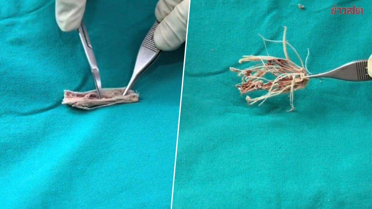 The Shocking Discovery: Surgeon Removes 30 Threads from Patient's Nose