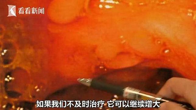 湖北1名男子日前被檢查出，腸道內有60多顆的息肉。(圖／翻攝自看看新聞)