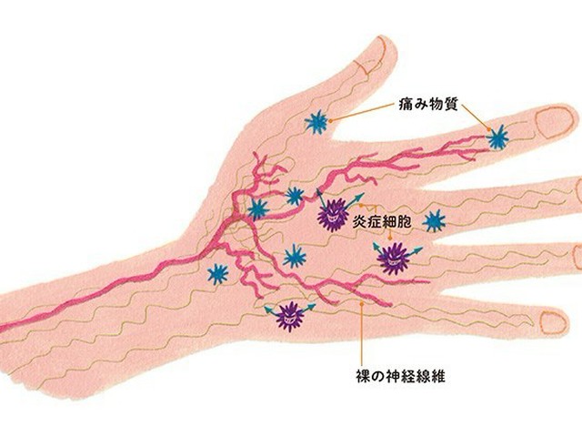 指の毛細血管が切れる 病気: 指の血管が切れる 痛い – YFKKC
