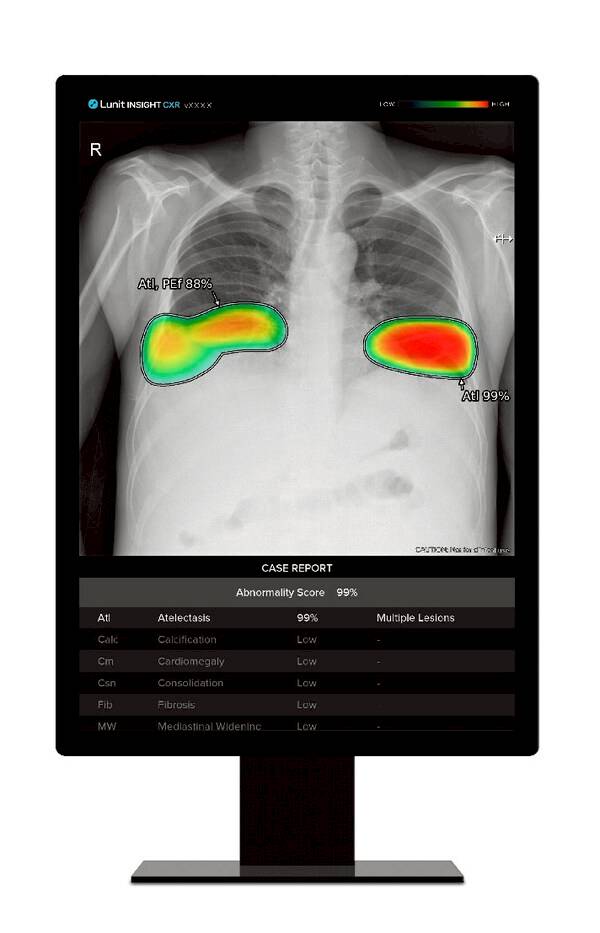 lunit-insight-cxr-excels-in-lung-nodule-detection-exceptional