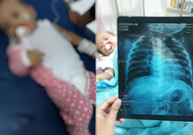 Bayi alami bronkopneumonia alibat endapan asap rokok sang ayah