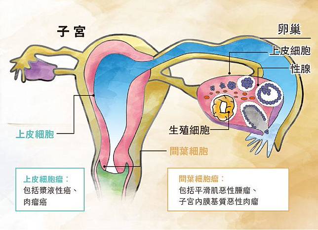 罕見婦科癌徵狀相似療法大不同 明報 Line Today