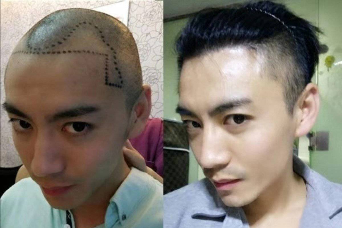 Millennial Chinese men going bald younger, getting hair transplants to