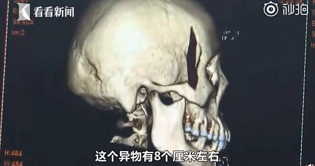 臉頰流膿醫取出8公分樹枝！竟是2年前摔跤惹禍