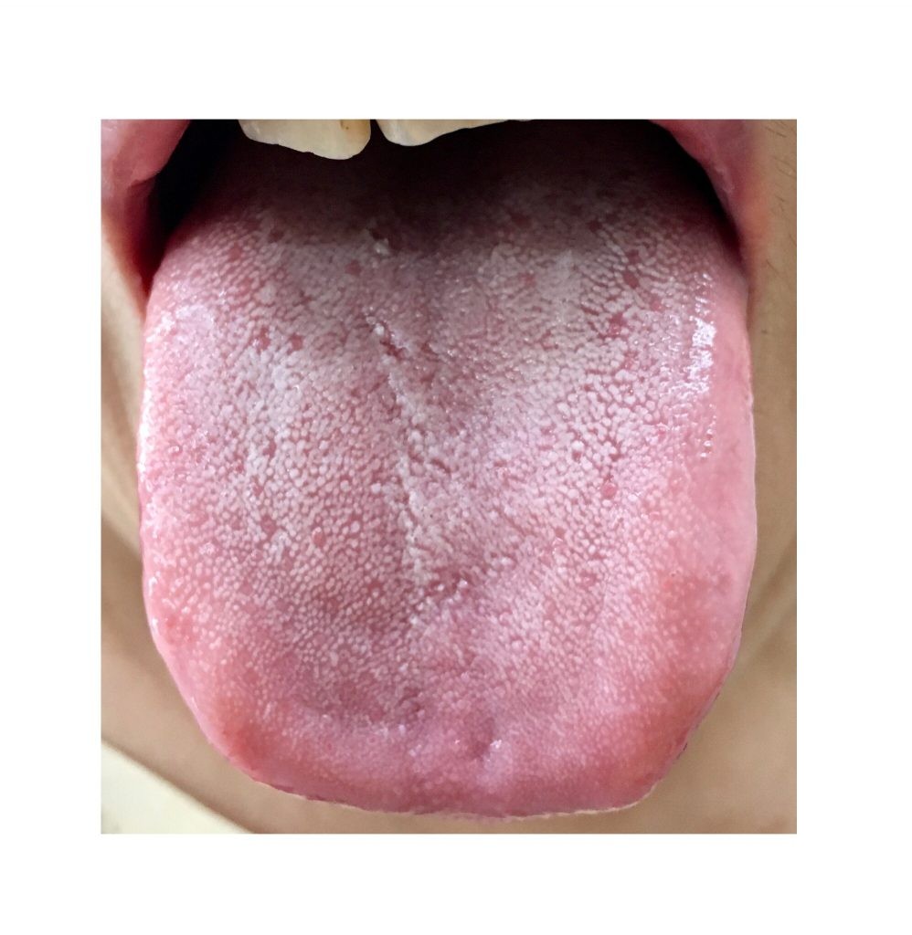 いつのまにか うつ 舌を見て今の自分に氣づいてね