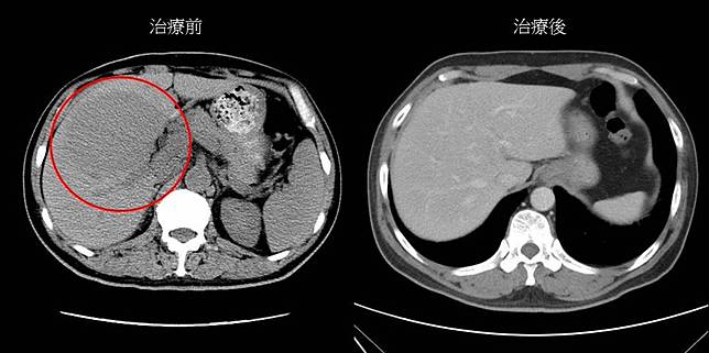 反胃、嘔吐「小症狀」就醫竟是巨大肝腫瘤  化療後還變大