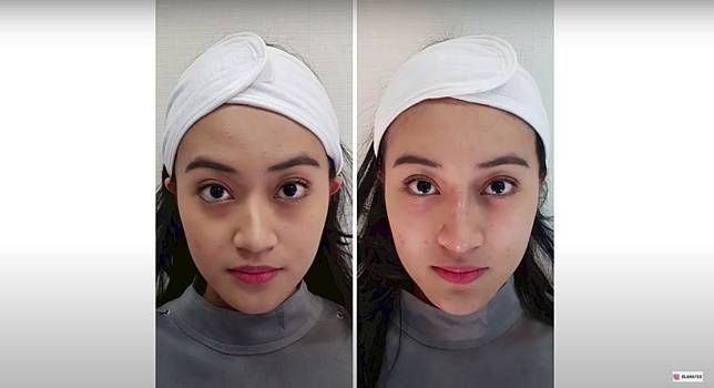 Beautyou Pengalaman Filler Hidung Selebgram Cantik Dalam Waktu 30 Menit Line Today Line Today