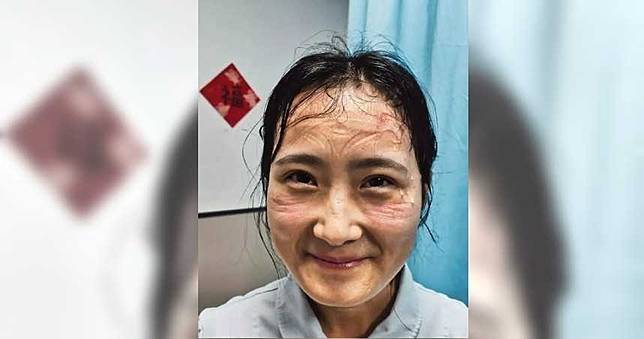 武漢肺炎／武漢護士滿臉防護罩勒痕！網淚讚：最美戰士