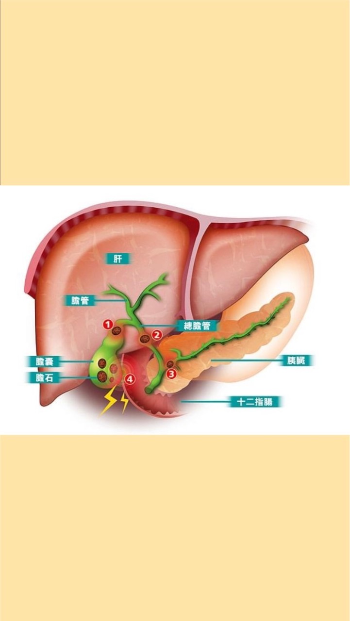 去去膽結石-交流互助討論區