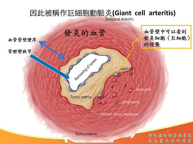 巨細胞動脈炎 不可輕忽的老年頭痛 勁報 Line Today