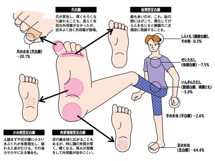 こう治す 水虫 白癬 の原因と対策 加齢のトリセツ