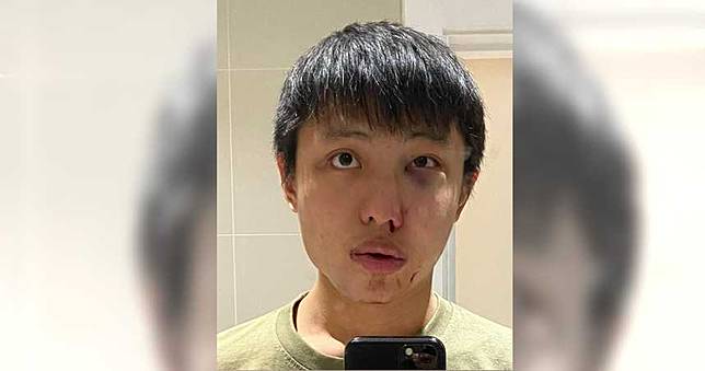 走在倫敦街頭被嗆「新冠病毒」！新加坡少年遭「種族主義者」圍毆