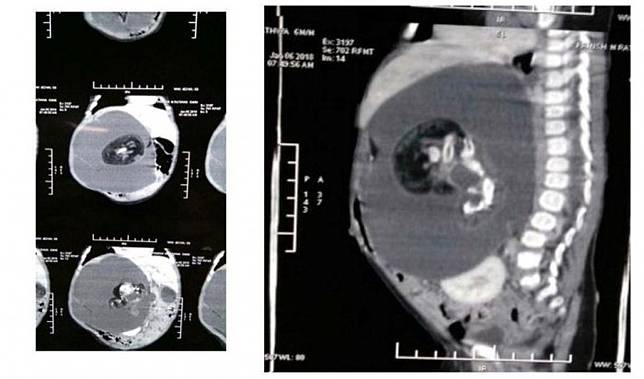 Dokter menunjukkan hasil X-ray perut Prinsha, kedua orang tuanya mengaku syok