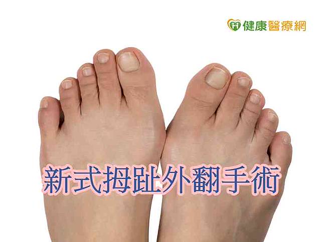 新式拇趾外翻矯正手術活動恢復快速 健康醫療網 Line Today