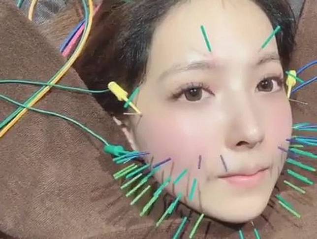 中醫也能做醫美 美顏針 改善老化兼保養 幾無副作用 康健雜誌