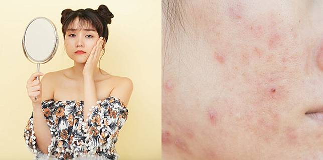 10 Penyebab Kemerahan Pada Kulit Wajah Ini Yang Perlu Dilakukan Theasianparent Line Today