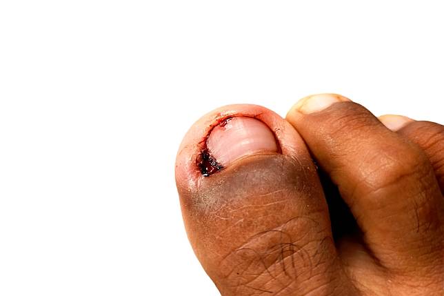 Paronychia,,Bleeding,Finger,With,Inflammation,Of,The,Nail,Caused,By