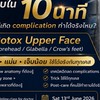 Botox Upper Face in 10 min Gr2 13/6/69
