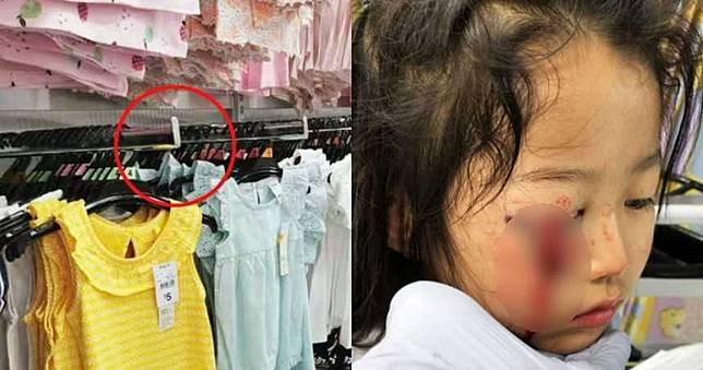 6歲女童遭金屬掛勾「插爆眼睛」　一塊肉掉下來…鮮血狂流