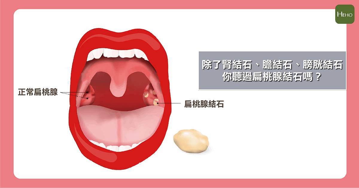 除了腎結石 膽結石 膀胱結石 你聽過扁桃腺結石嗎 Heho健康 Line Today