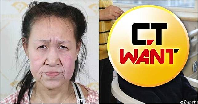 15歲少女罹罕病「滿臉鬆弛如老婦」　整型後變這樣！