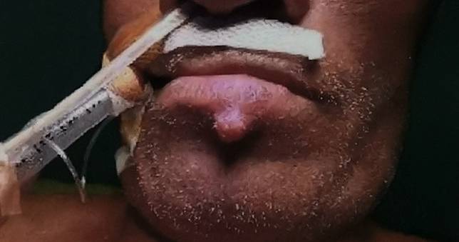 嚇人！！阿伯下唇冒痘不為意 竟是癌症轉移