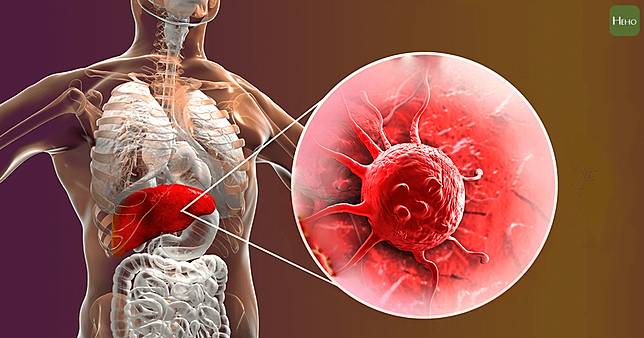 肝臟長出血管瘤會惡化成癌症嗎 你該擔心的是這個 Heho健康 Line Today