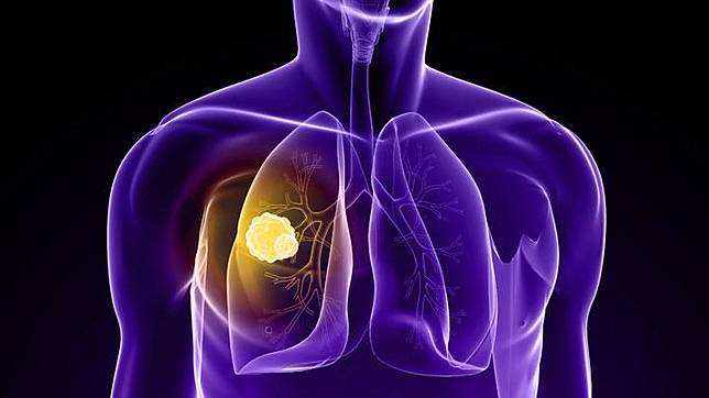  pasien kanker paru adalah operasi, kemoterapi, radiasi, dan terapi target.