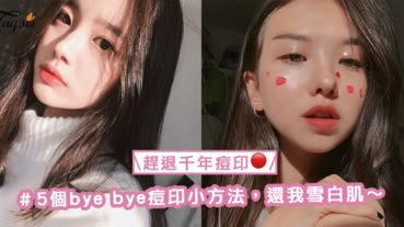 痘痘要滅很快，千年痘印卻遲遲不走！5個bye bye痘印小方法，還我雪白肌〜
