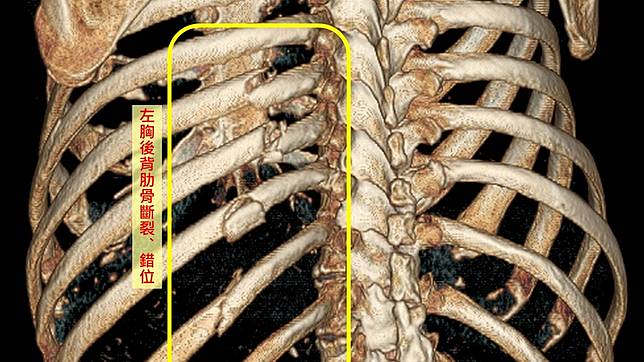 九旬翁肋骨骨折疼痛肋骨骨板固定術助早復元 Tcnews 慈善新聞網 Line Today