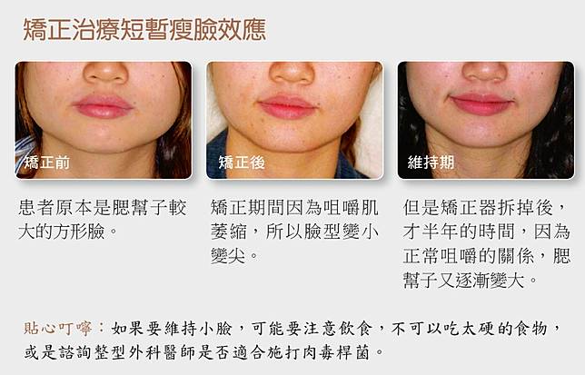 拆牙套後會變瓜子臉 牙齒矯正與臉型改變的關係 健康遠見 Line Today