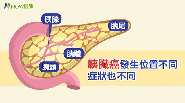 åœ‹è¡›é™¢æ‰¾å‡ºå°ç£èƒ°è‡Ÿç™Œæ‚£è€…é›žå°¾é…'ç™‚æ³•å¯å¢ž1å€å­˜æ´»æœŸ Nowå¥åº· Line Today