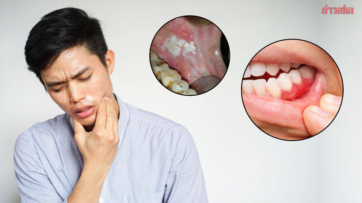 Check out the 6 warning signs of mouth cancer.  Mouth ulcers – swollen lumps  If you experience this symptom, you should immediately see a dentist | Khaosod