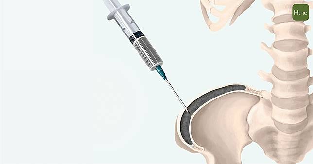 骨質疏鬆可以灌 骨水泥 骨折痛到站不起來 手術隔天就能走 Heho健康 Line Today