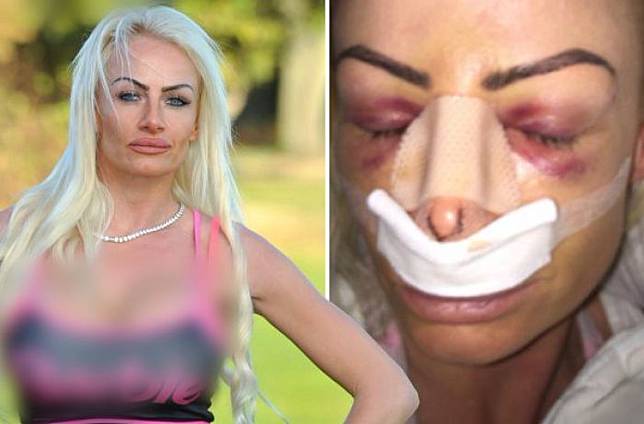 Sempat Tak Disukai Suami, Perempuan Ini Habiskan Uang Rp2,4 Miliar untuk Operasi Agar Menjadi Barbie Hidup dari Inggris