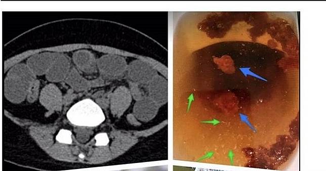 爸嫌腿粗胖！16歲少女「吃掉一條棉被」減重　腹痛吐綠汁
