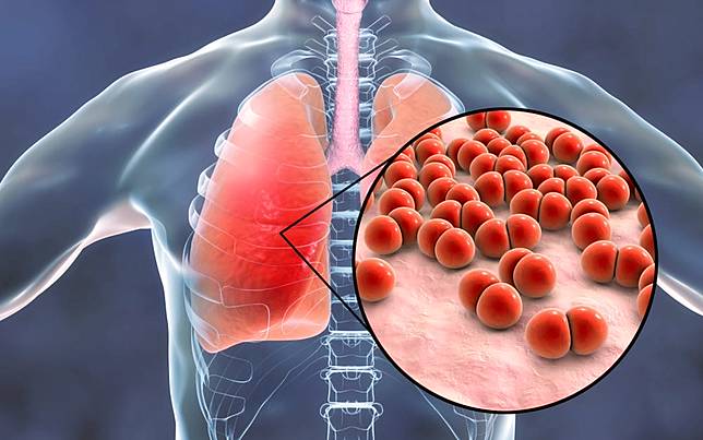 肺炎為肺部的急性感染！多休息喝水與服藥緩解