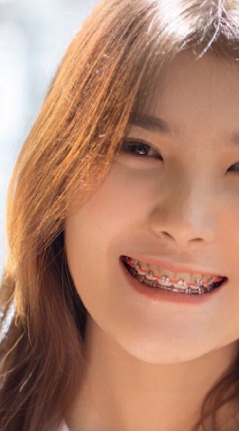 ชมรมคน จัดฟัน