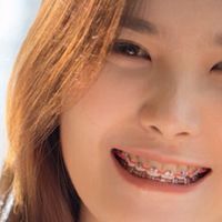 ชมรมคน จัดฟัน