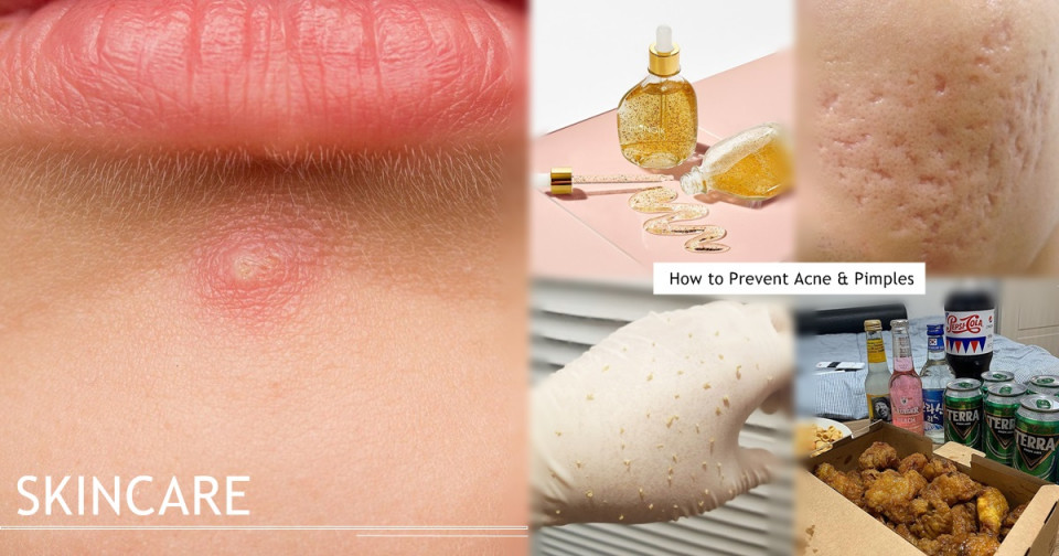 造成成人痘原因1：壓力、生活作息