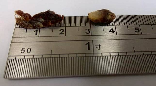 醫生教你正確清理耳垢方法 3歲童疑失聰求醫夾出2cm 巨型耳屎 Sundaykiss Line Today